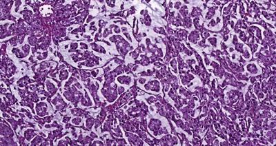 Case Report: Chemoimmunotherapy in microsatellite-instability-high advanced goblet cell carcinoma of the colon